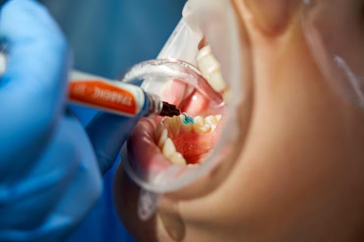 periodontitis treatment